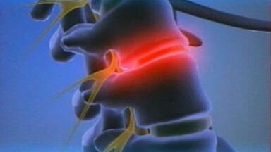 osteocondroză lombară acută durere de genunchi drept stâng